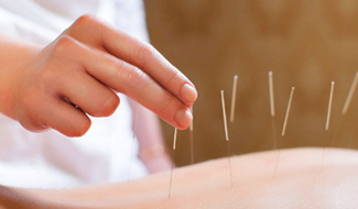 Was Ist Akupunktur?