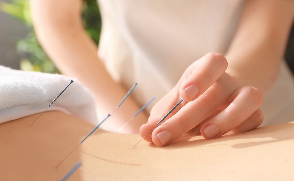 Acupuncture at Vitalica Wellness